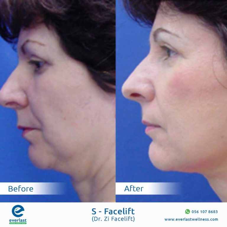 Everlast wellness medical center Before After s facelift 2 1 768x768