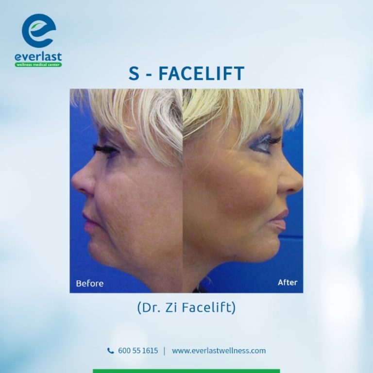 Everlast wellness medical center Before After s facelift 3 768x768