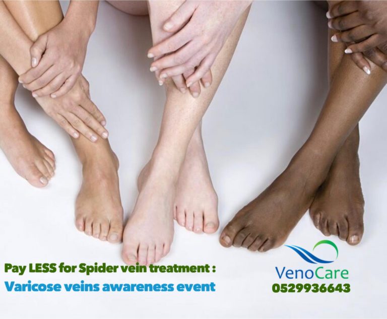 varicose veins 03 768x633